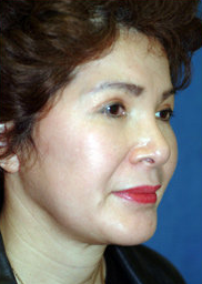 Facelift and Chin Implant