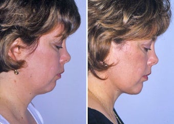 Liposuction of neck and chin augmentation