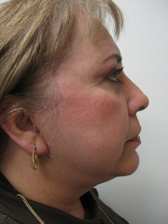 Chin Implant