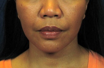 Chin Implant with Laser Facelift