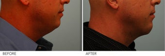 Chin Implant and Neck Liposuction