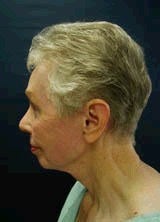 Chin Implants