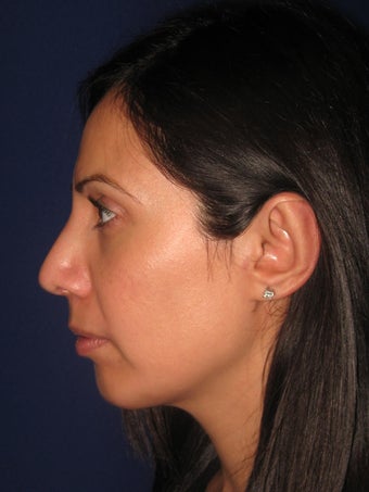 Chin Augmentation (Chin Implant)