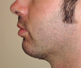 Chin Augmentation