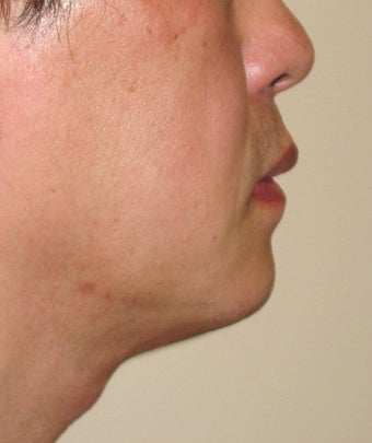 Chin Augmentation with Liposuction Neck