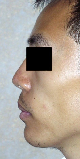 Chin Augmentation