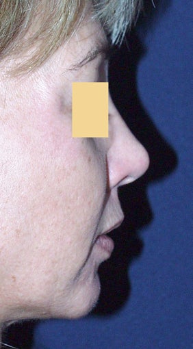 Chin Augmentation