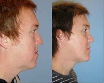 Chin Augmentation