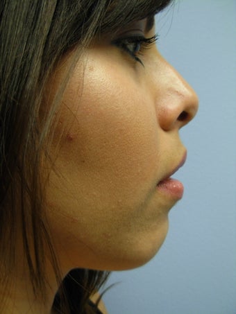 Chin Augmentation