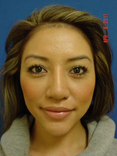 Chin Augmentation/rhinoplasty