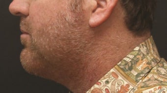 Chin Implant and Laser-Assisted Lipocontouring of Neck