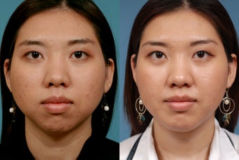 Chin Augmentation