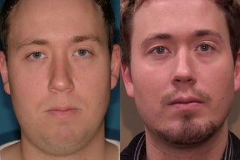 Chin Augmentation