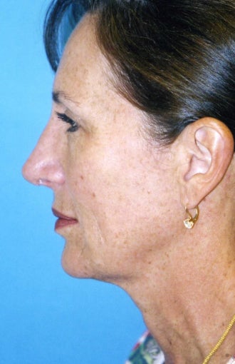 Chin Implant