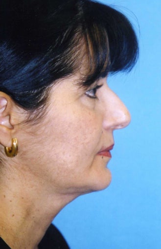 Chin Implant