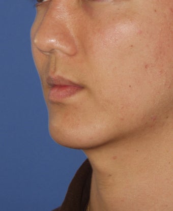 Chin Implant