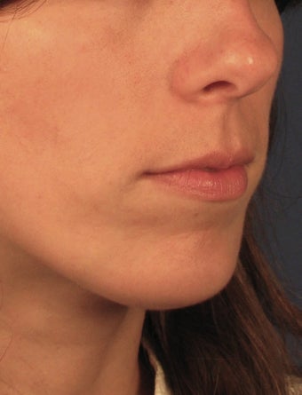 Chin Implant