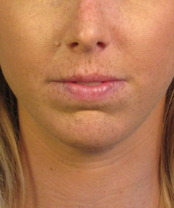 Chin Implant
