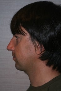 Chin Implant