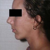 Chin Implant