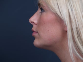Chin Implant