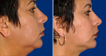 Chin Implant