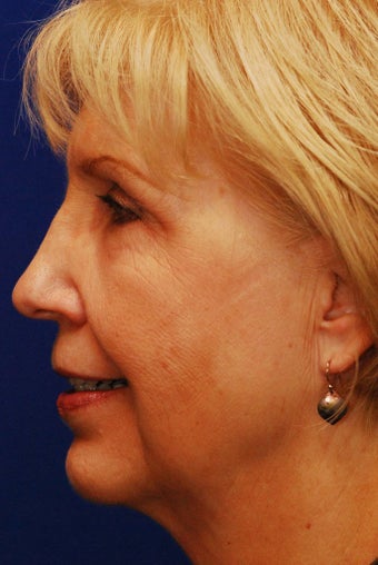 Chin Implant