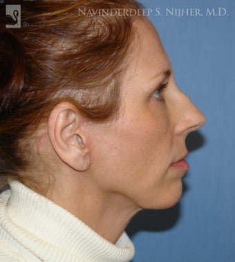 Chin Implant