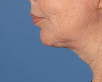 Chin Implant