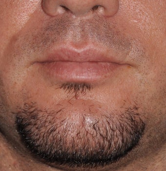 Chin Augmentation