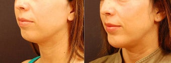 Chin Implant Surgery