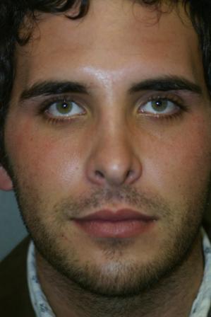 Chin Implant