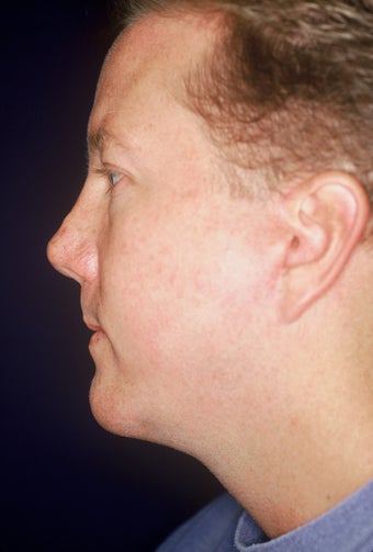 Chin Implant