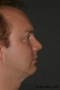 Chin Augmentation 