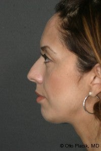 Chin Augmentation 
