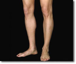 Calf Implant