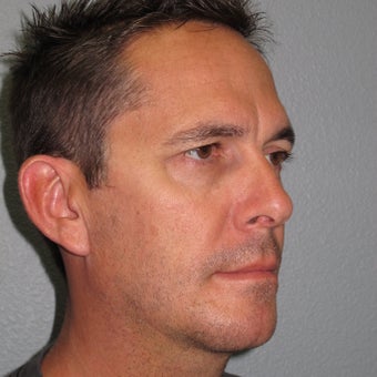 Chin Implant and Neck Liposuction