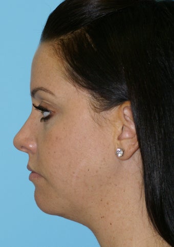 Chin Implant