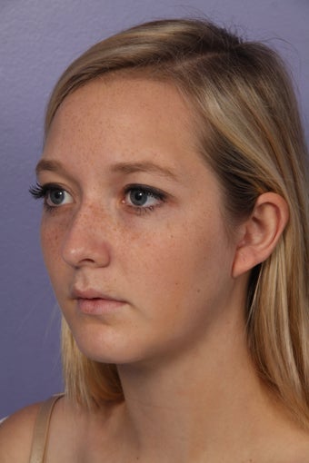 Chin Augmentation and Liposuction of the Neck