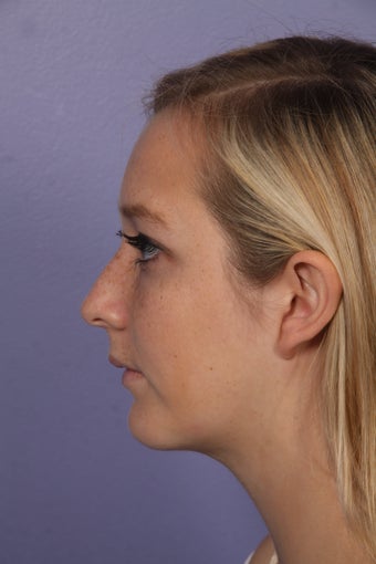 Chin Augmentation and Liposuction of the Neck