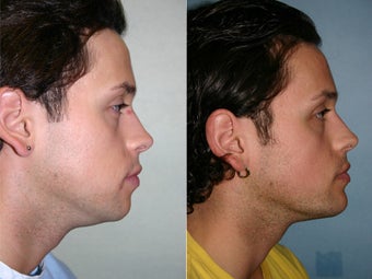 chin augmentation