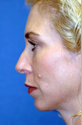 Chin Implant and Rhinoplasty