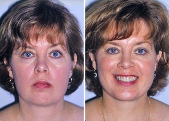 Liposuction of neck and chin augmentation