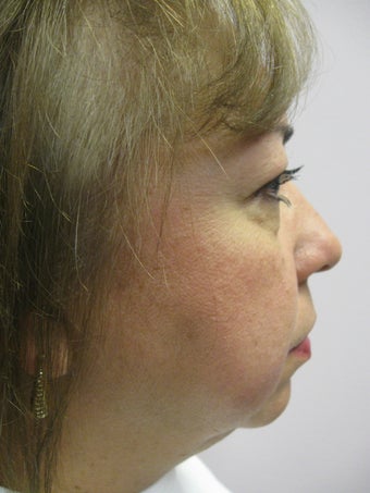 Chin Implant