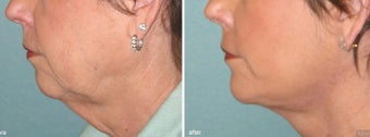 Chin Implant with Facelift