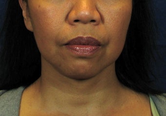 Chin Implant with Laser Facelift