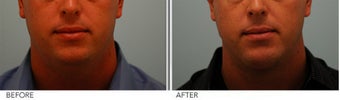 Chin Implant and Neck Liposuction