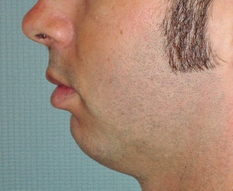 Chin Augmentation