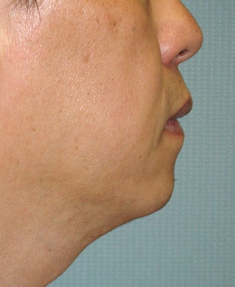 Chin Augmentation with Liposuction Neck