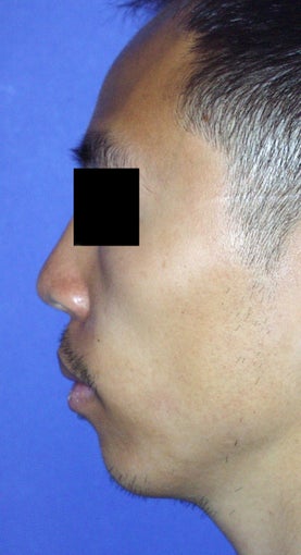 Chin Augmentation